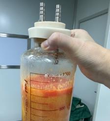 东莞水动力吸脂手术要做多久？